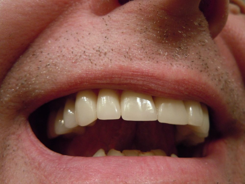 Come avere denti bianchi: consigli e rimedi